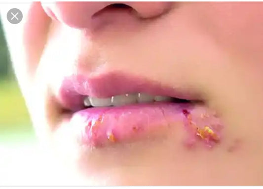 How to handle Canker Sores!
