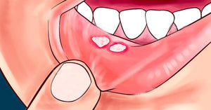 Canker Sore – A REAL PAIN!